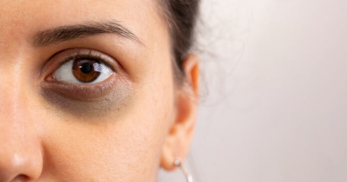 Ayurvedic methods to eliminate dark circles