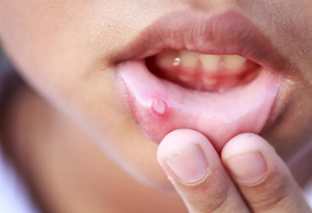 Home remedies for mouth ulcers