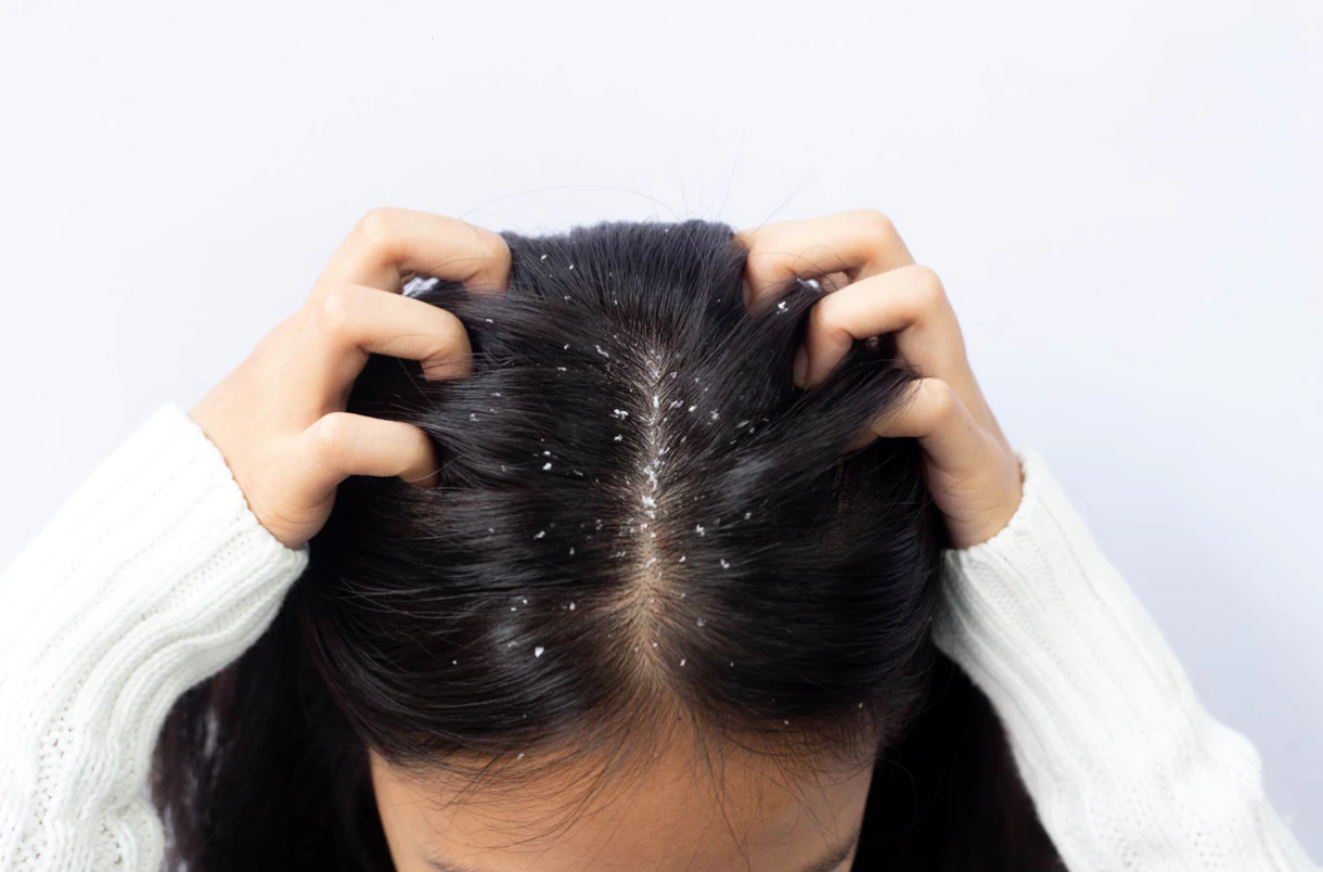 how to cure dandruff at home.